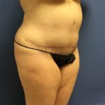 Tummy Tuck Before & After Patient #2649