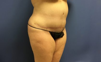 Tummy Tuck Before & After Patient #2649