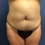 Tummy Tuck Before & After Patient #2649