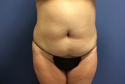 Tummy Tuck Before & After Patient #2649