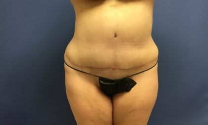 Tummy Tuck Before & After Patient #2649