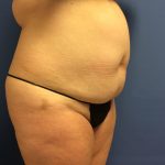 Tummy Tuck Before & After Patient #2649