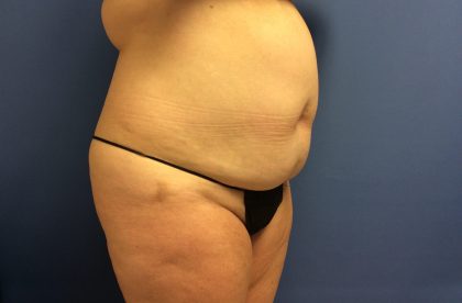 Tummy Tuck Before & After Patient #2649