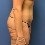 Tummy Tuck Before & After Patient #2654