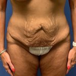 Tummy Tuck Before & After Patient #2654