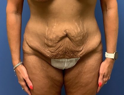 Tummy Tuck Before & After Patient #2654