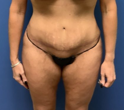 Tummy Tuck Before & After Patient #2654