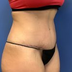 Tummy Tuck Before & After Patient #2659