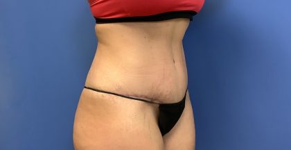 Tummy Tuck Before & After Patient #2659