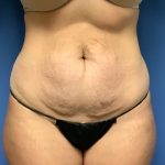 Tummy Tuck Before & After Patient #2659