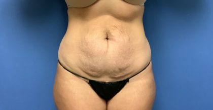 Tummy Tuck Before & After Patient #2659