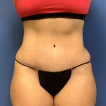 Tummy Tuck Before & After Patient #2659