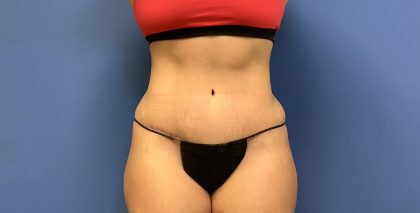 Tummy Tuck Before & After Patient #2659