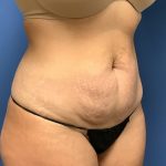 Tummy Tuck Before & After Patient #2659