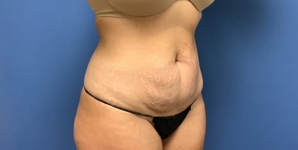 Tummy Tuck Before & After Patient #2659