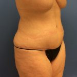 Tummy Tuck Before & After Patient #2664