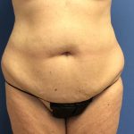 Tummy Tuck Before & After Patient #2664