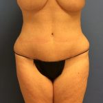 Tummy Tuck Before & After Patient #2664