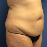 Tummy Tuck Before & After Patient #2664