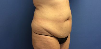 Tummy Tuck Before & After Patient #2664