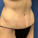 Tummy Tuck Before & After Patient #2669