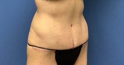 Tummy Tuck Before & After Patient #2669