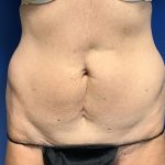 Tummy Tuck Before & After Patient #2669