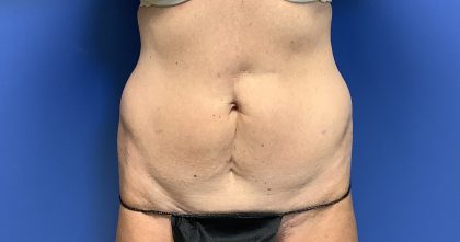 Tummy Tuck Before & After Patient #2669