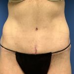 Tummy Tuck Before & After Patient #2669