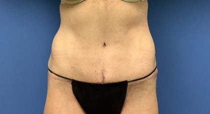 Tummy Tuck Before & After Patient #2669