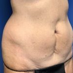 Tummy Tuck Before & After Patient #2669