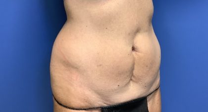 Tummy Tuck Before & After Patient #2669