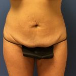 Tummy Tuck Before & After Patient #2674