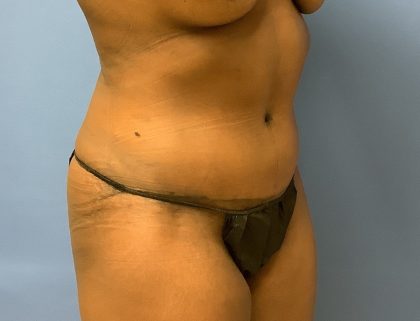 Tummy Tuck Before & After Patient #2679
