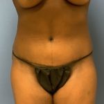 Tummy Tuck Before & After Patient #2679