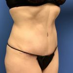 Tummy Tuck Before & After Patient #2684