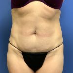Tummy Tuck Before & After Patient #2684
