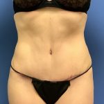 Tummy Tuck Before & After Patient #2684