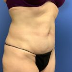 Tummy Tuck Before & After Patient #2684