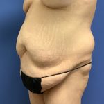 Tummy Tuck Before & After Patient #2689