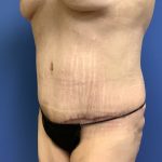 Tummy Tuck Before & After Patient #2689