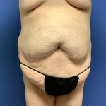 Tummy Tuck Before & After Patient #2689