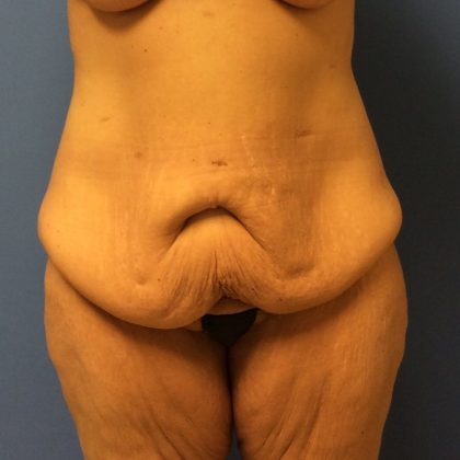 Tummy Tuck Before & After Patient #2694