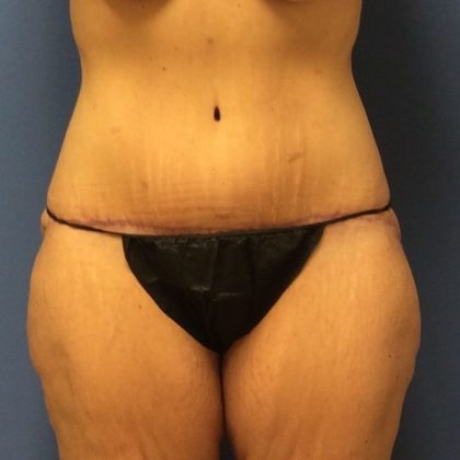 Tummy Tuck Before & After Patient #2694