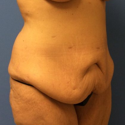 Tummy Tuck Before & After Patient #2694