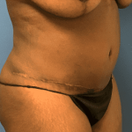 Tummy Tuck Before & After Patient #2699