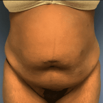 Tummy Tuck Before & After Patient #2699