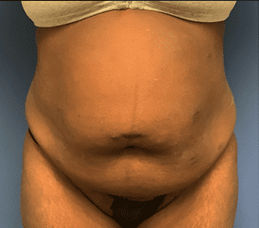 Tummy Tuck Before & After Patient #2699