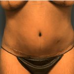 Tummy Tuck Before & After Patient #2699