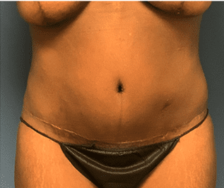 Tummy Tuck Before & After Patient #2699